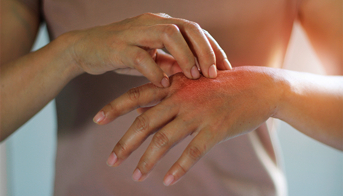 Qué es la dermatitis y cómo tratarla